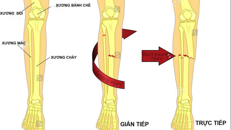gãy 1 3 dưới xương cẳng chân - Image 4