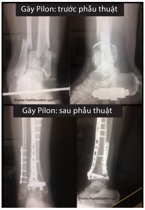 gãy 1 3 dưới xương chày - Image 4