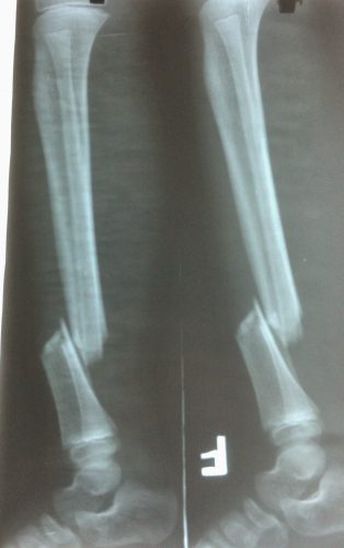 gãy 2 xương cẳng chân - Image 3
