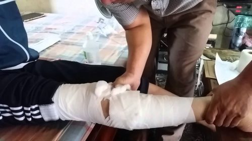 gãy chân mấy tháng đi được - Image 4