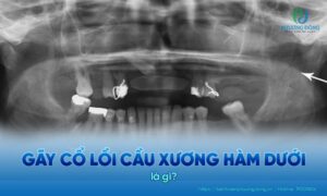 gãy cổ lồi cầu xương hàm dưới