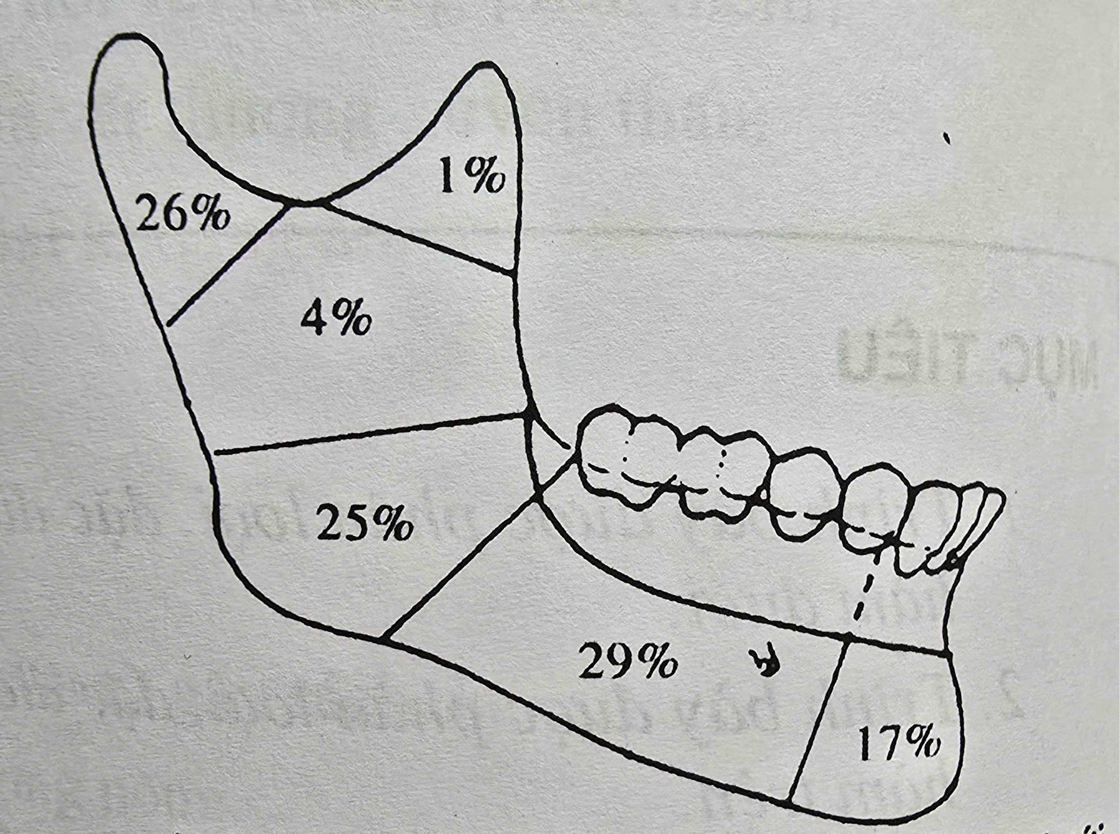gãy cổ lồi cầu xương hàm dưới - Image 4