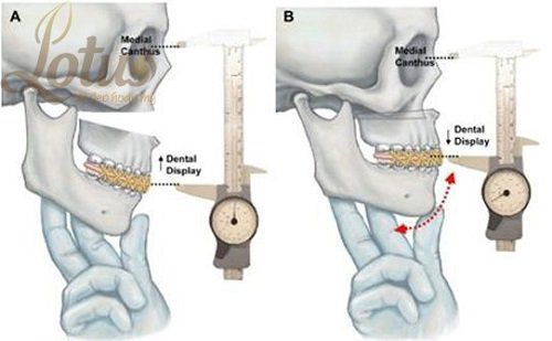 gãy cổ lồi cầu xương hàm dưới - Image 5