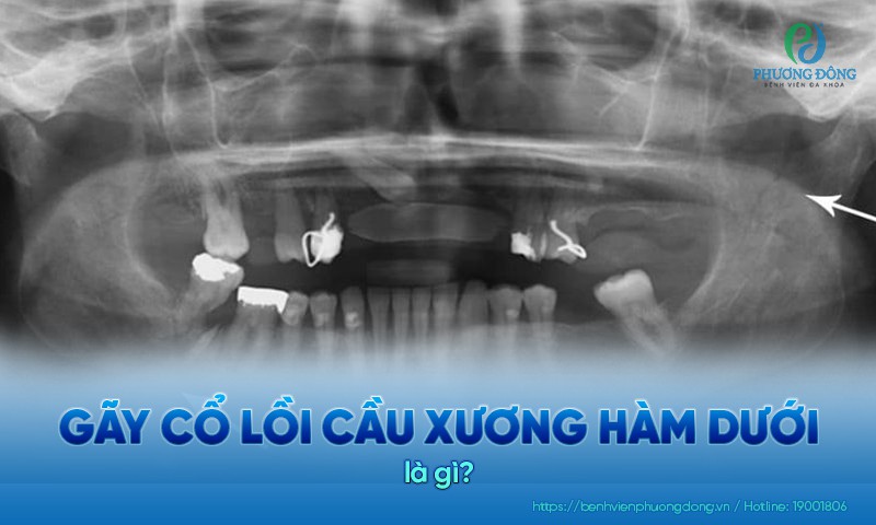 gãy cổ lồi cầu xương hàm dưới