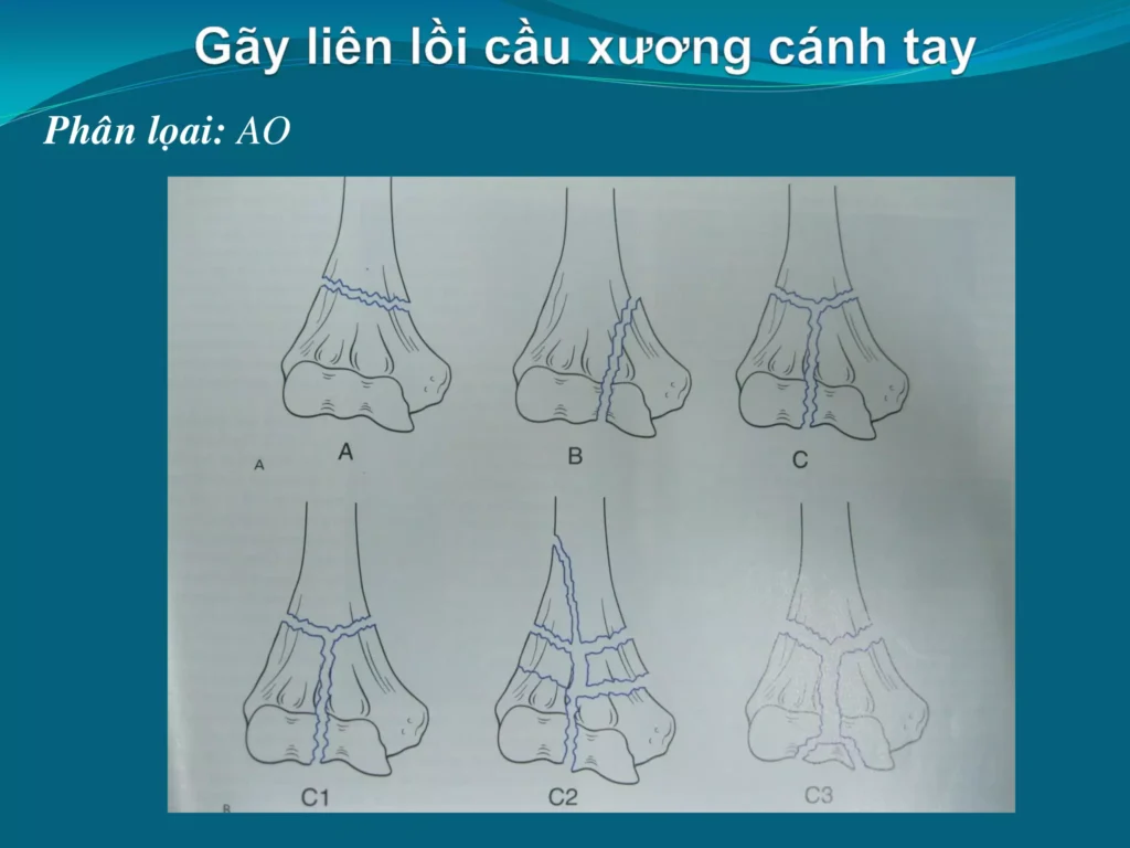 gãy đầu dưới xương cánh tay