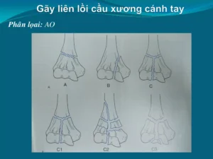 gãy đầu dưới xương cánh tay