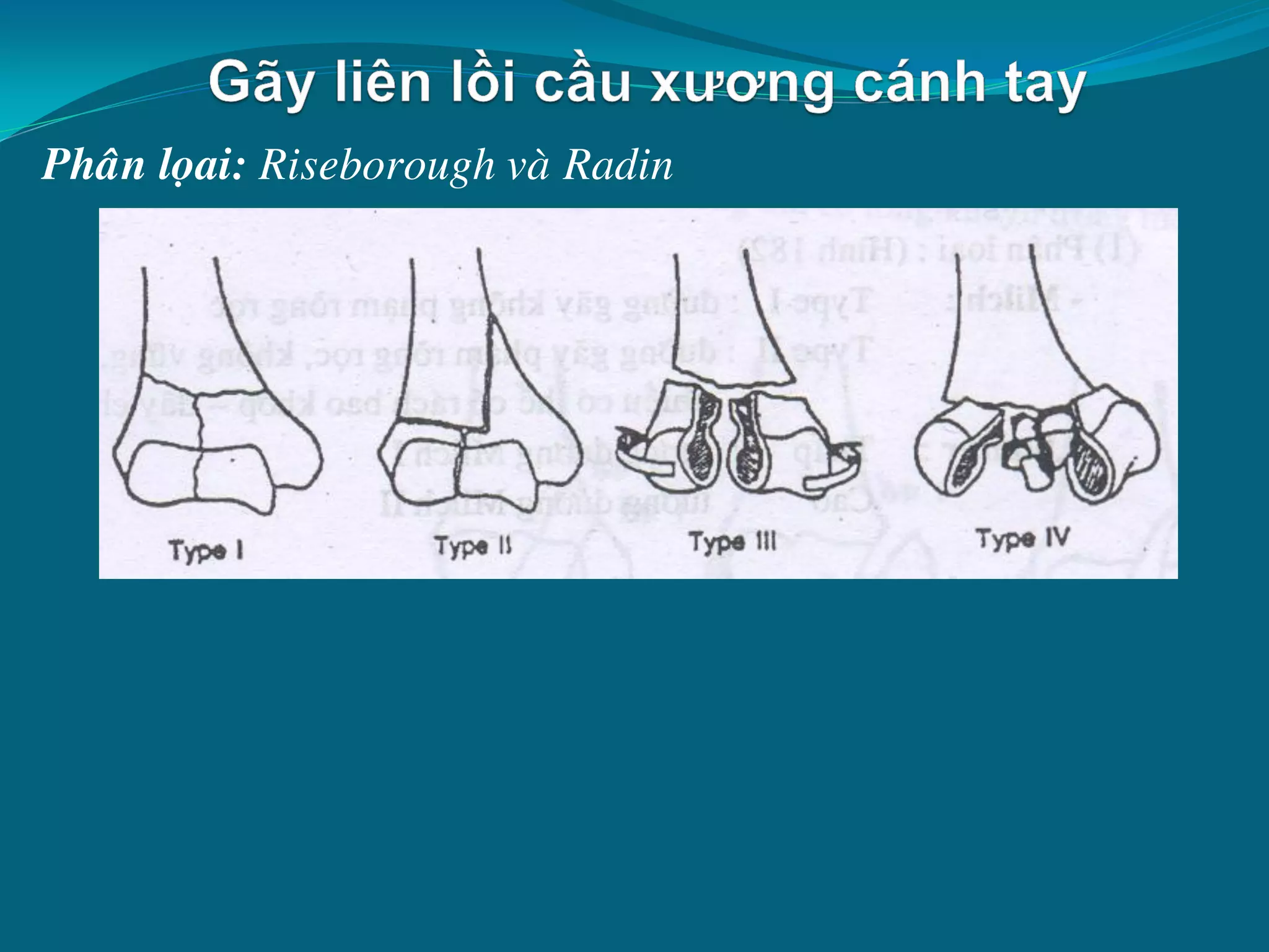 gãy đầu dưới xương cánh tay - Image 3