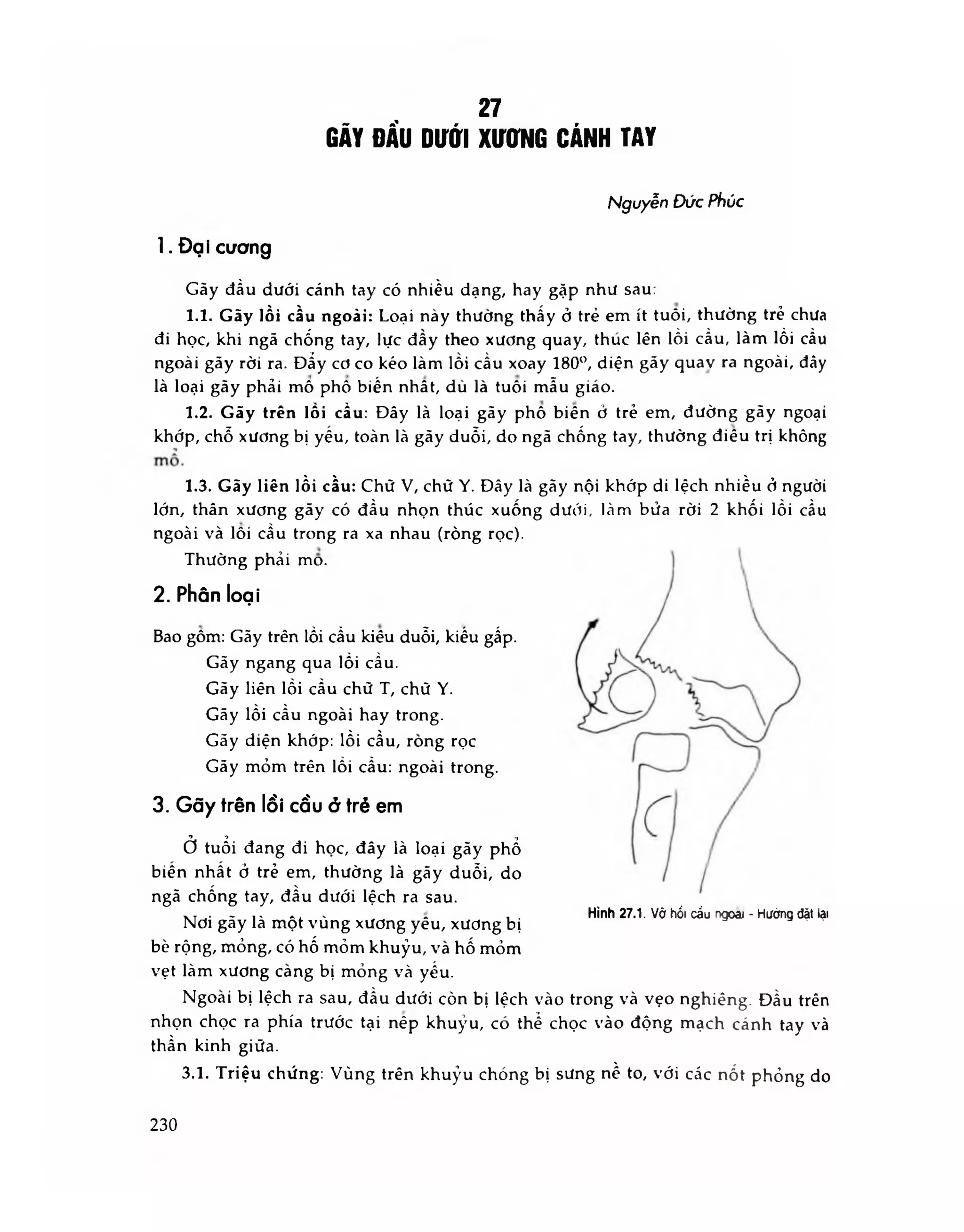 gãy đầu dưới xương cánh tay - Image 4