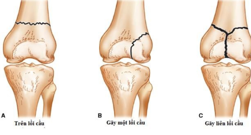 gãy đầu dưới xương đùi - Image 1