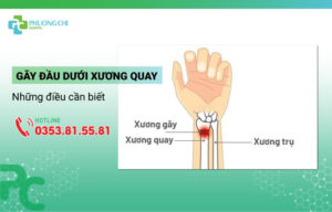 gãy đầu dưới xương quay