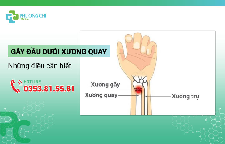 gãy đầu dưới xương quay