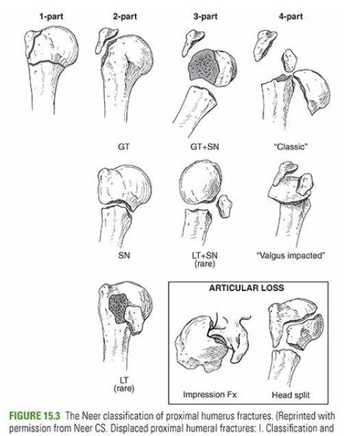 gãy đầu trên xương cánh tay - Image 3