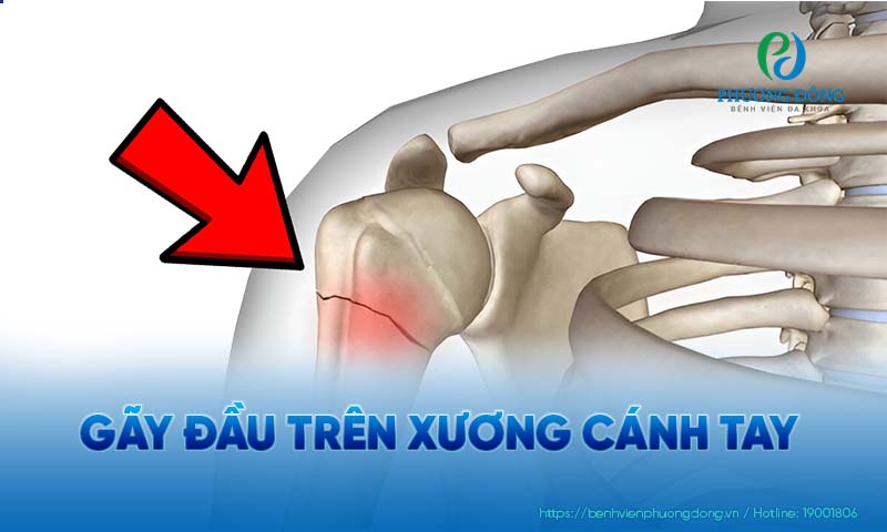 gãy đầu trên xương cánh tay - Image 4