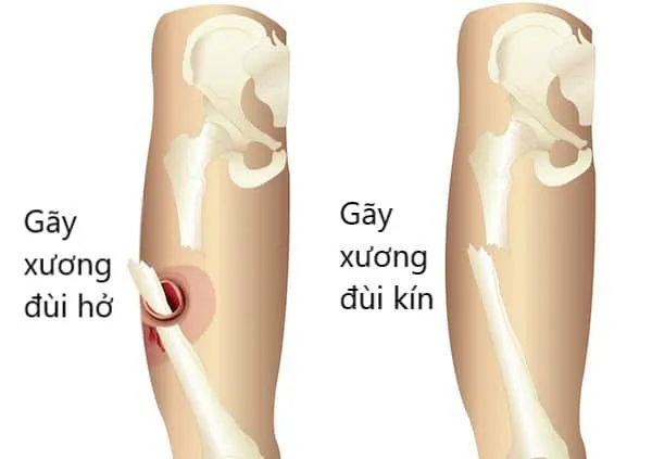 gãy đùi