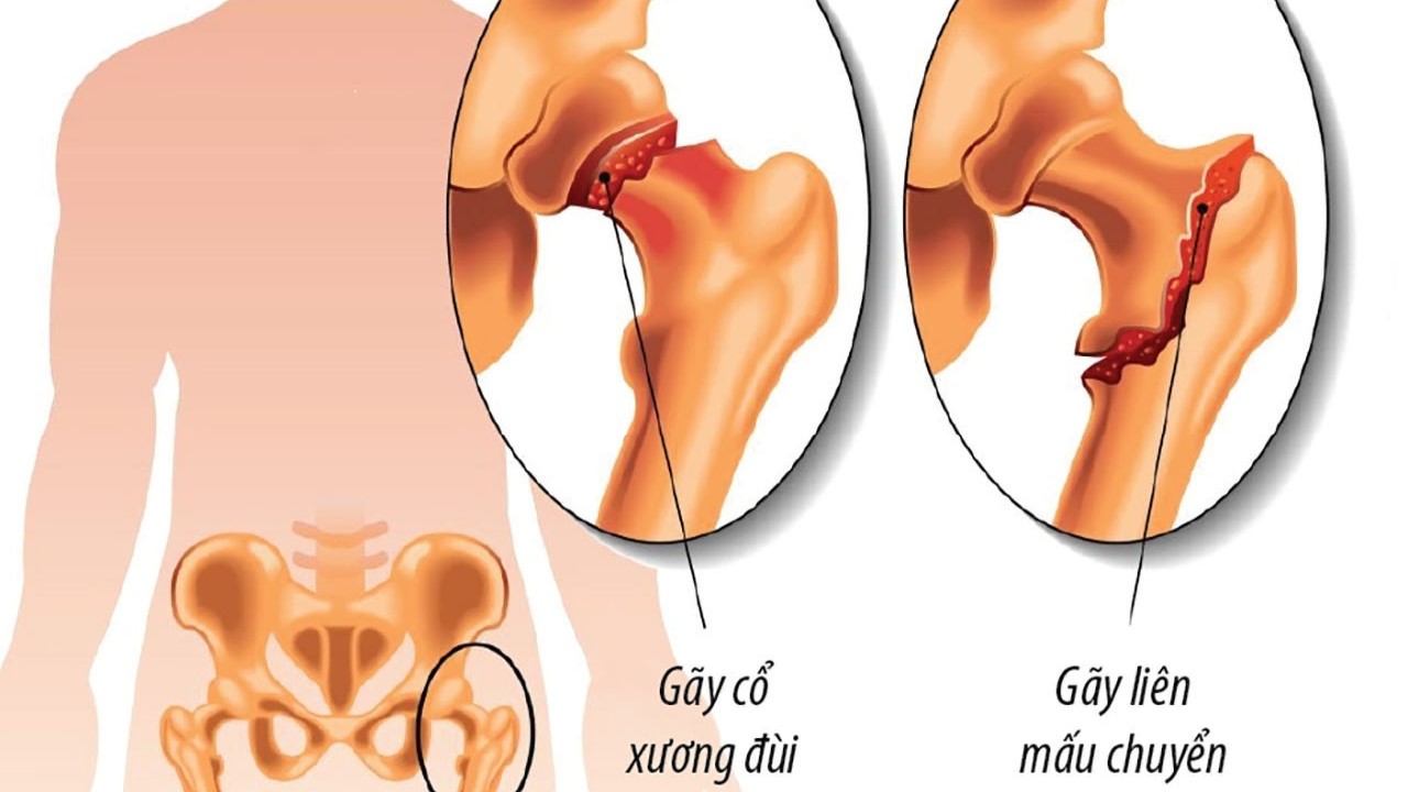 gãy liên mấu chuyển xương đùi - Image 2