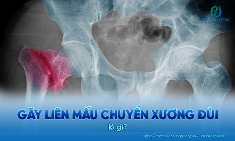 gãy liên mấu chuyển xương đùi - Image 3