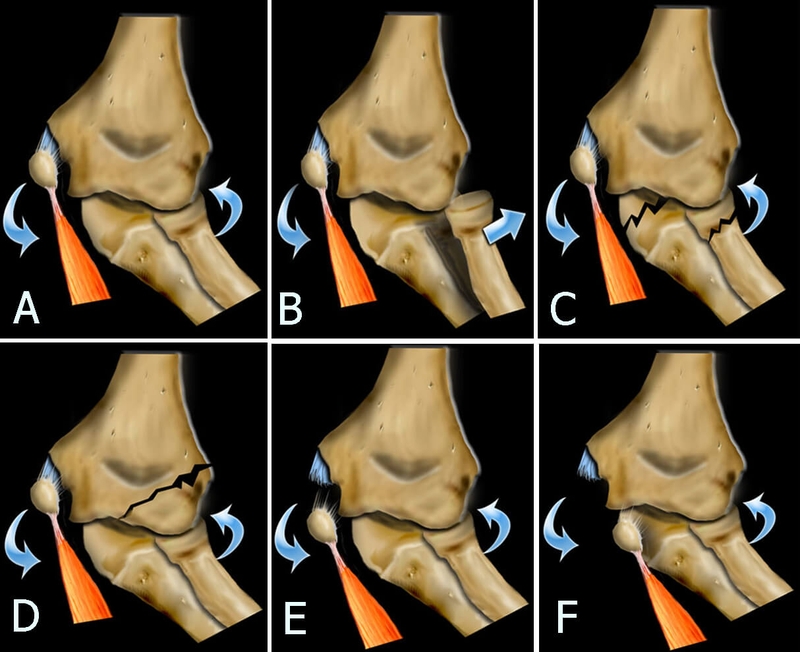 gãy lồi cầu trong xương cánh tay - Image 3