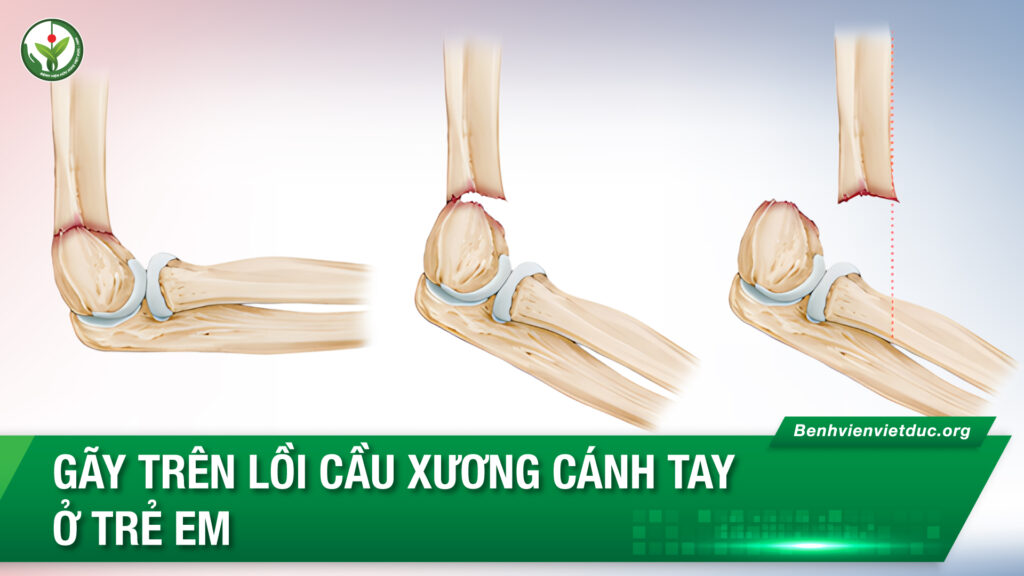 gãy lồi cầu xương cánh tay