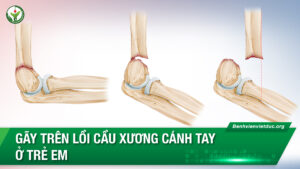 gãy lồi cầu xương cánh tay
