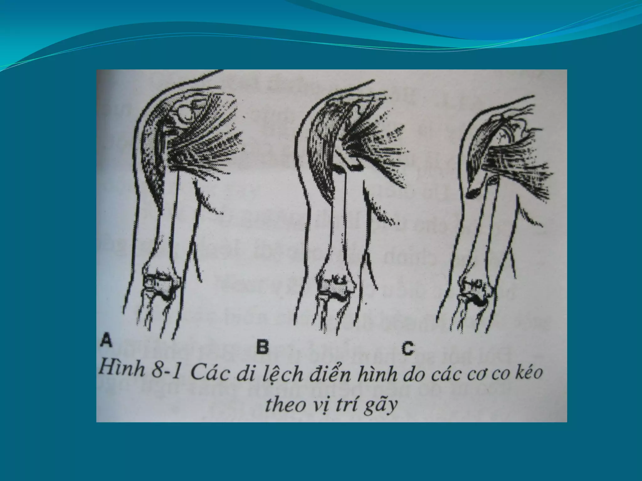 gãy thân xương cánh tay - Image 5