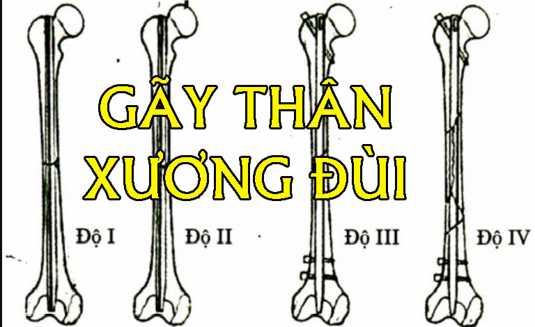 gãy thân xương đùi - Image 2