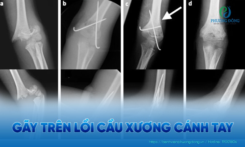 gãy trên lồi cầu xương cánh tay - Image 2