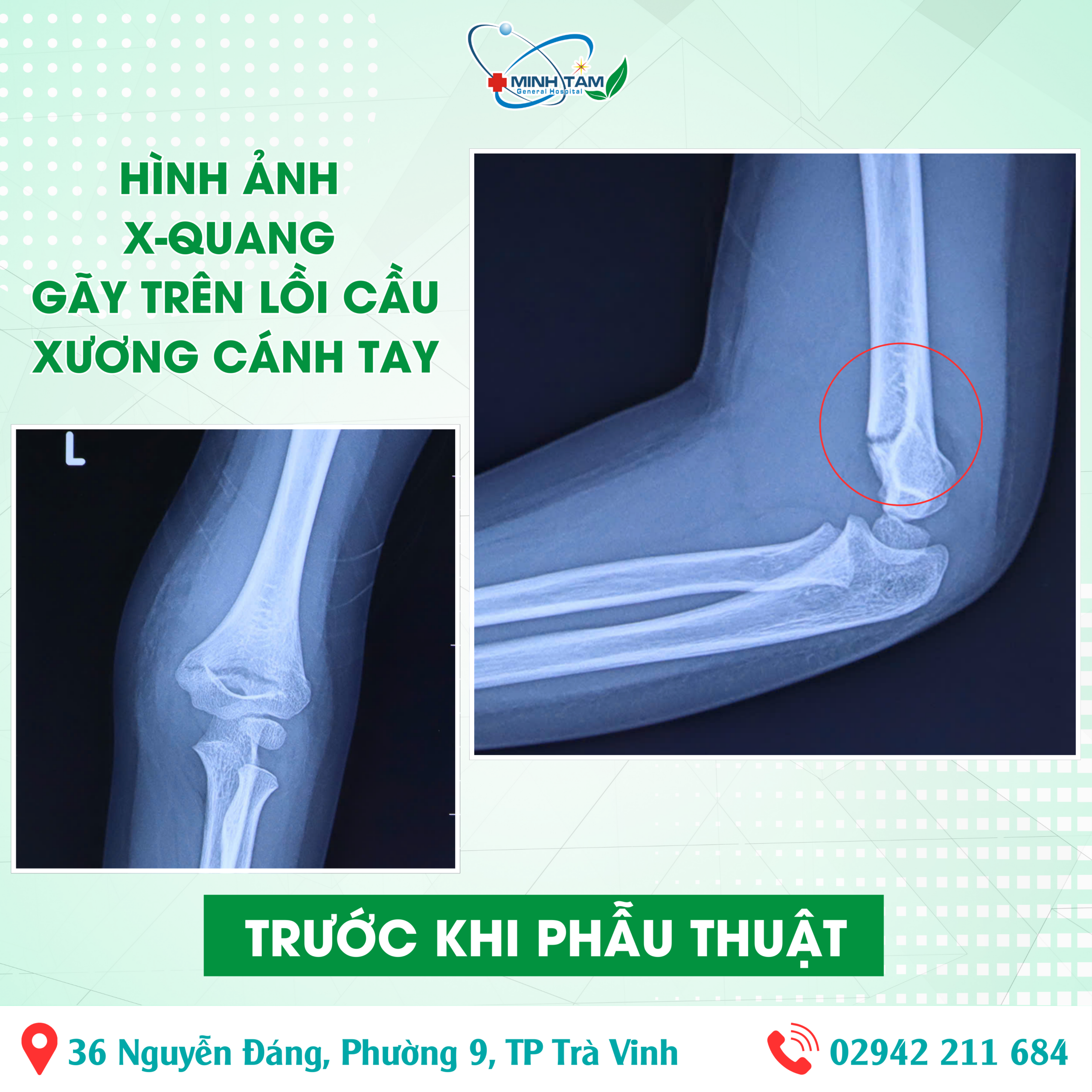 gãy trên lồi cầu xương cánh tay - Image 3