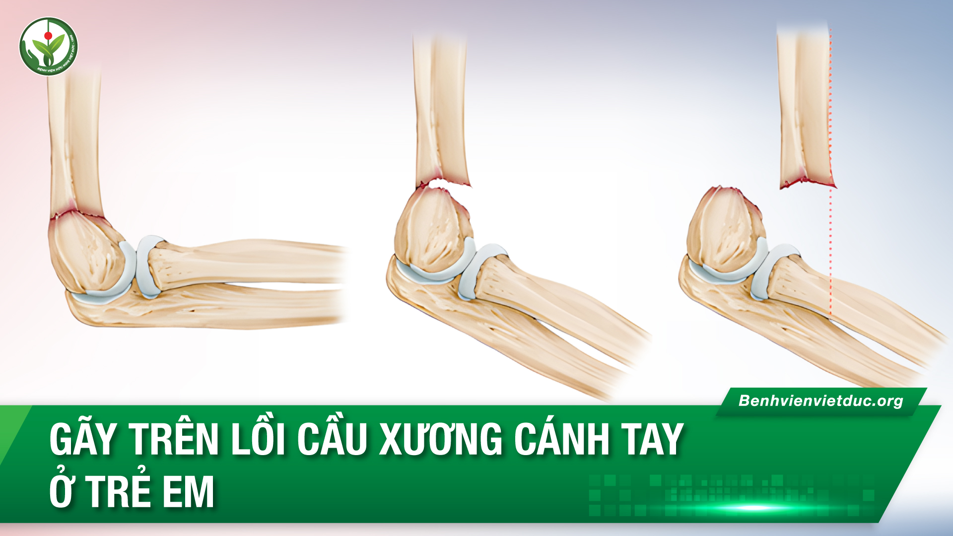 gãy trên lồi cầu xương cánh tay - Image 1