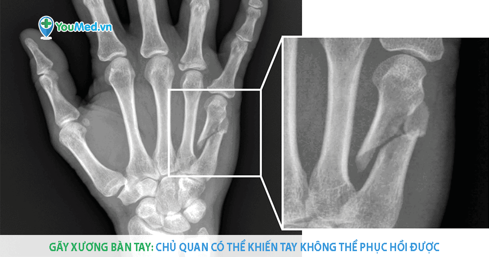 gãy xương bàn tay - Image 2