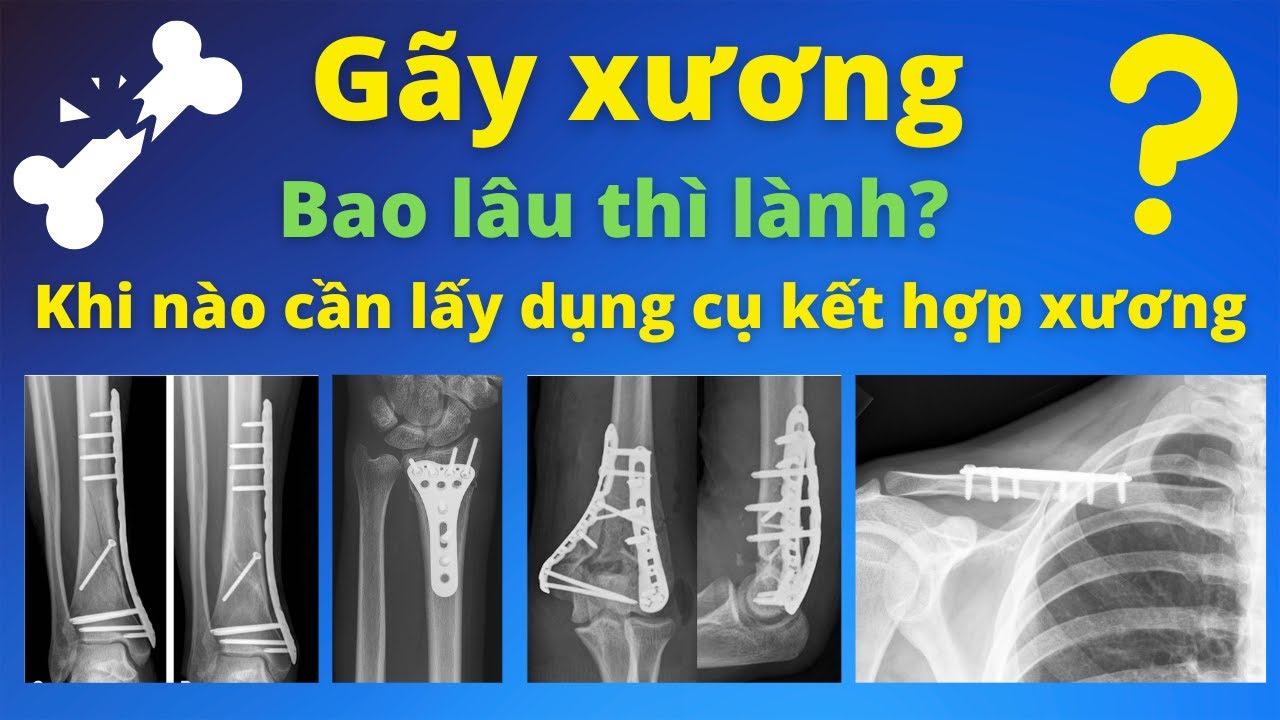 gãy xương bao lâu thì lành - Image 5