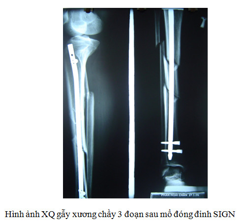 gãy xương cẳng chân - Image 3