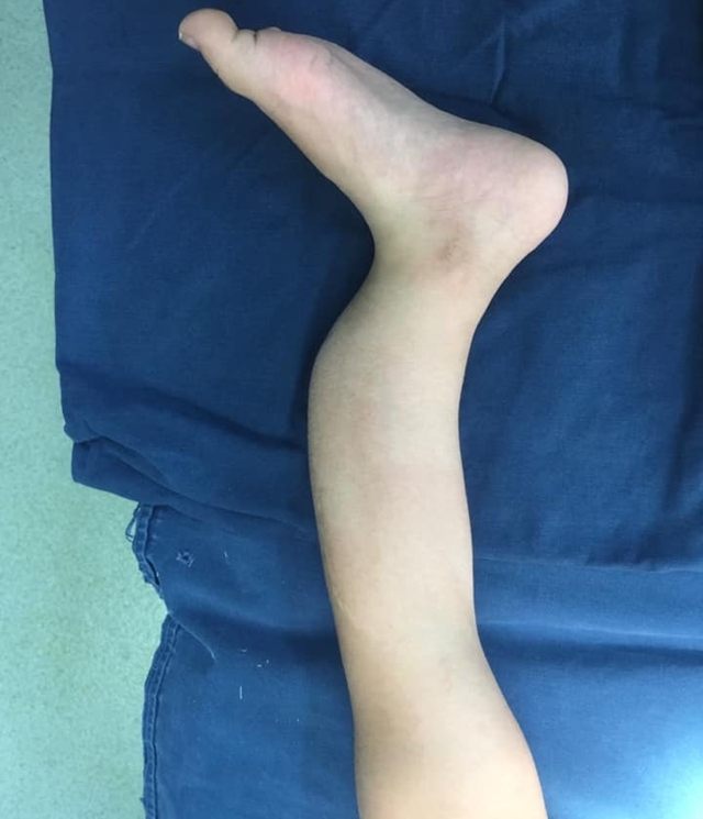 gãy xương cẳng chân ở trẻ em - Image 4