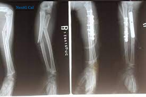 gãy xương cẳng tay bao lâu thì lành - Image 4