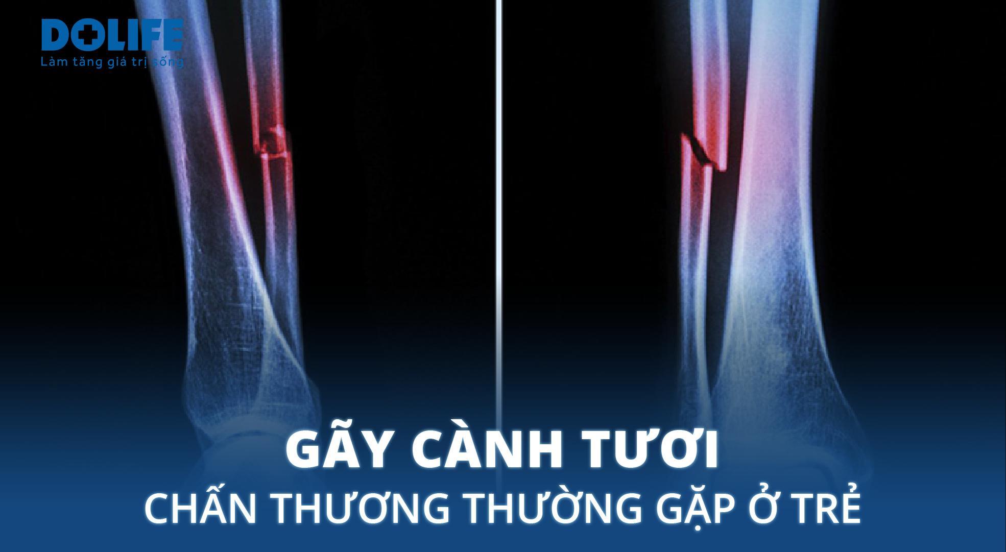 gãy xương cành tươi - Image 4