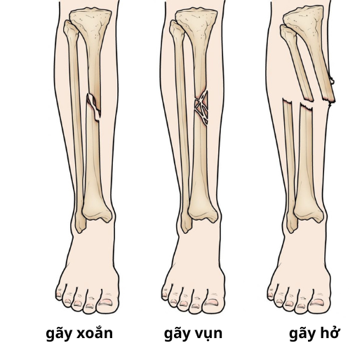 gãy xương chân - Image 5