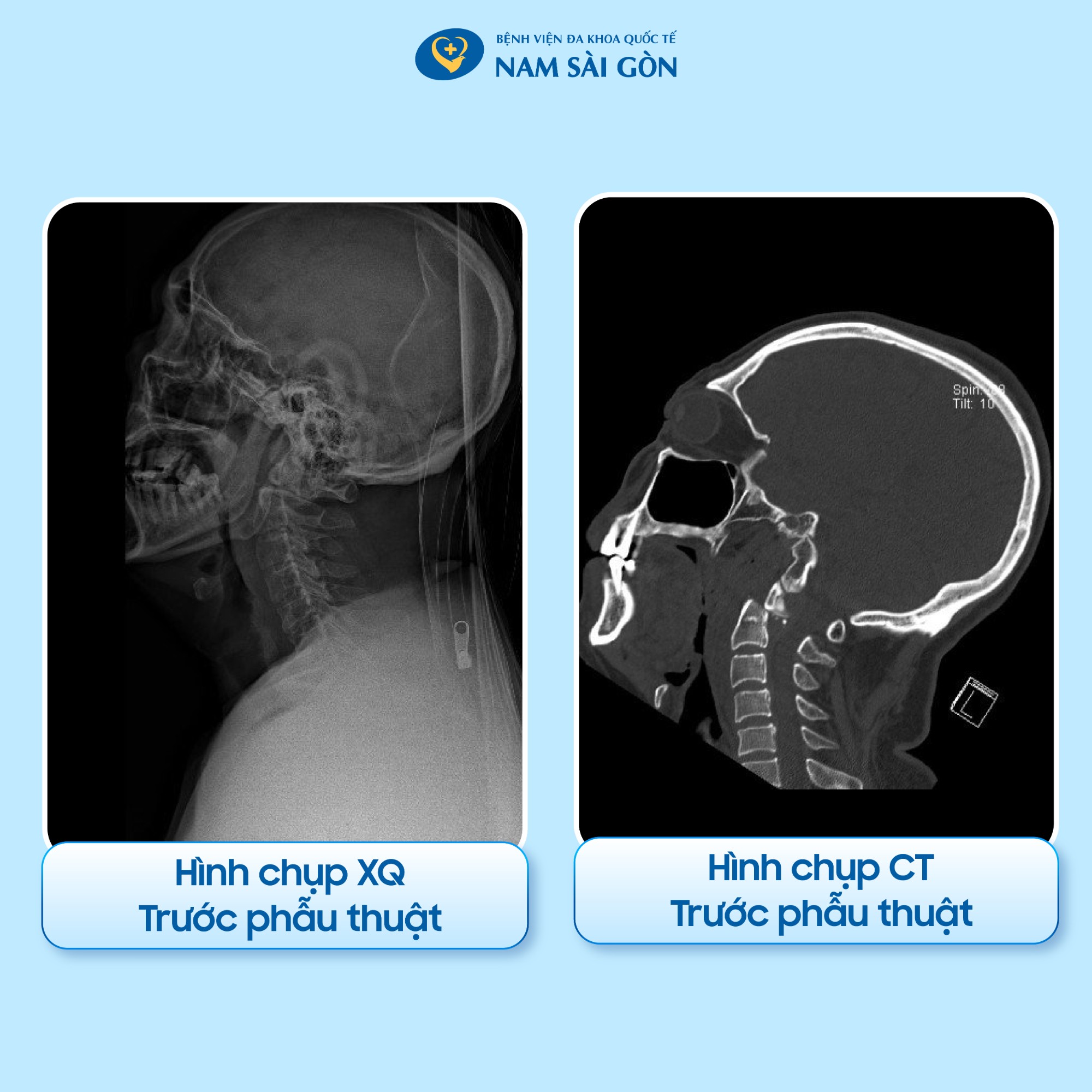 gãy xương cổ có chết không - Image 4