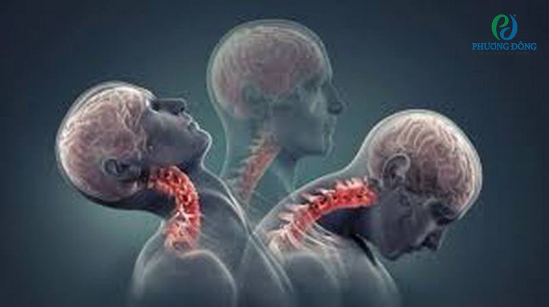 gãy xương cổ có chết không
