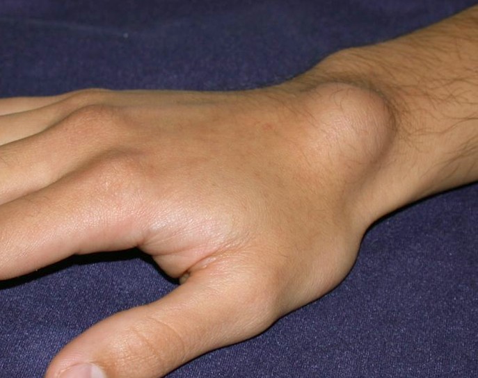 gãy xương cổ tay bị sưng - Image 3