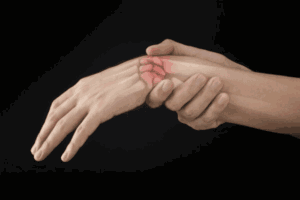 gãy xương cổ tay bị sưng