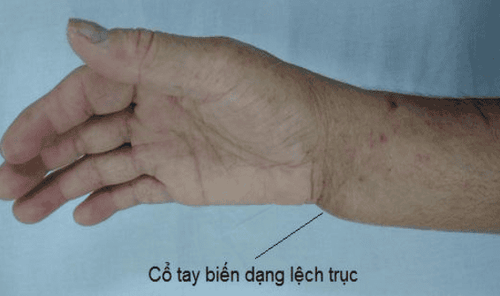 gãy xương cổ tay bị sưng - Image 5