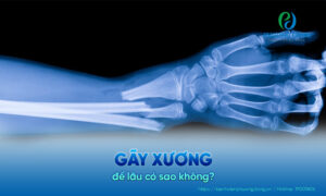 gãy xương để lâu có sao không