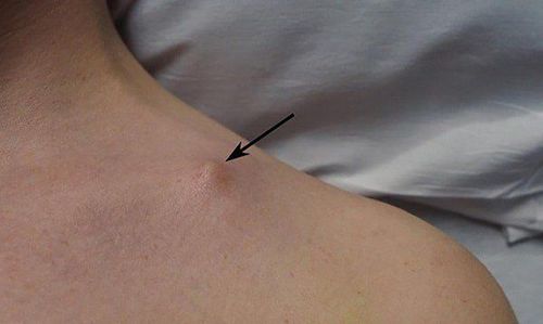 gãy xương đòn có cần bó bột không - Image 3