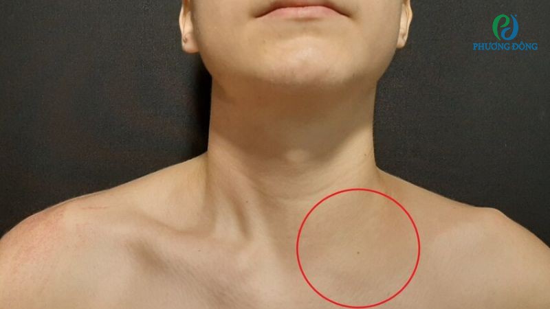 gãy xương đòn di lệch - Image 3