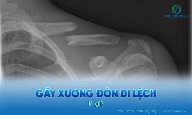 gãy xương đòn di lệch - Image 4