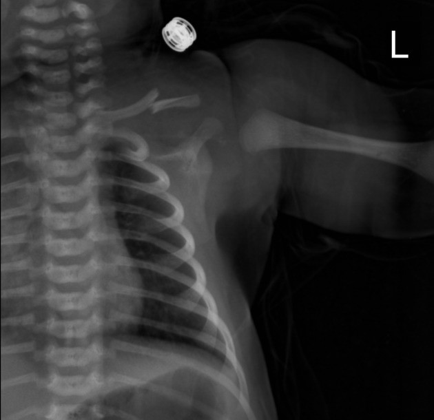 gãy xương đòn ở trẻ em - Image 3