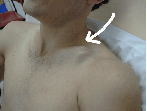 gãy xương đòn vai trái - Image 4