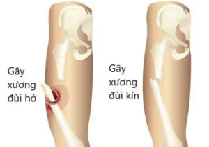 gãy xương đùi