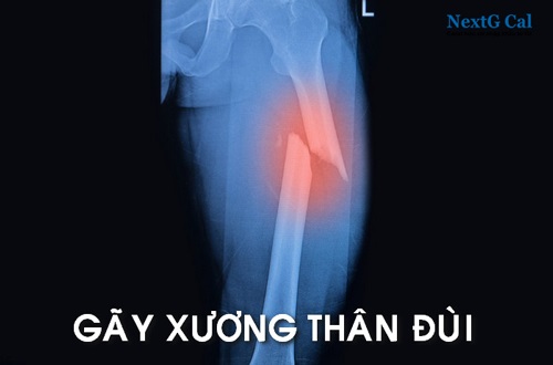 gãy xương dùi bao lâu thì lành - Image 2