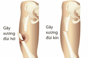 gãy xương dùi bao lâu thì lành