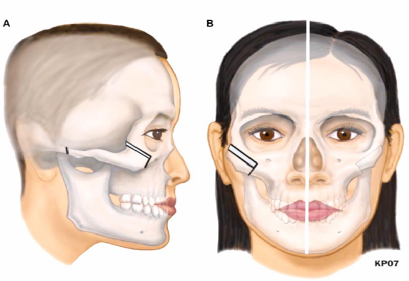 gãy xương gò má - Image 4